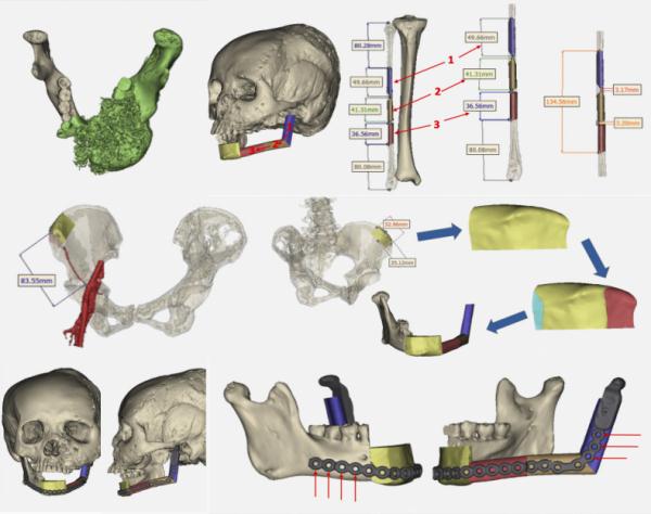 女子長著一張“猿臉”，30年無法見人！醫生為她重建五官，實現從“猿”到人