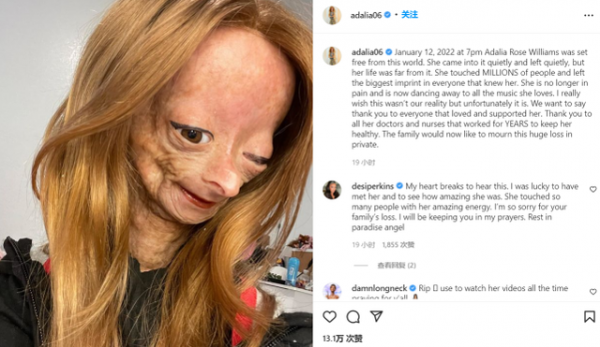 知名網紅阿達莉亞·羅斯因早衰症去世，年僅15歲，家人公佈死訊