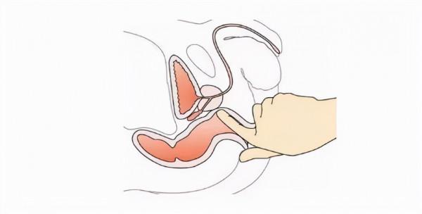 肛腸檢查:你到底在怕什麼 肛腸檢查:你到底在怕什麼