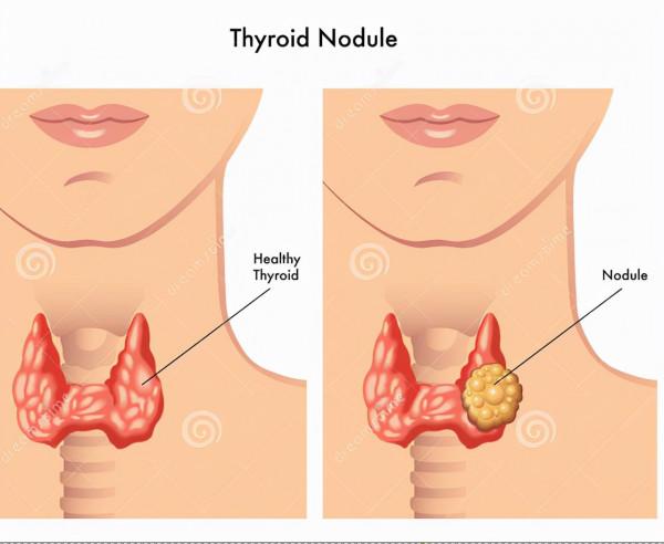 一餓就&OpenCurlyDoubleQuote;心慌、手抖、無力&rdquo;，這是什麼情況？是低血糖嗎？