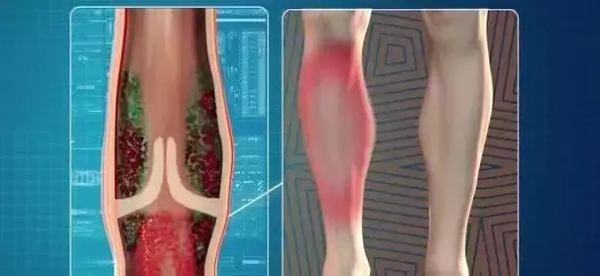 心臟瓣膜出問題，全身會遭殃！日常兩招助你強心臟