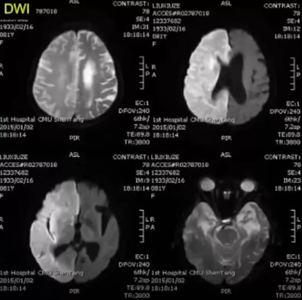 急性腦梗死MRI的臨床特點，超強解讀