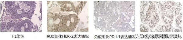 病例分享 | 維迪西妥單抗(RC-48)聯合PD-1在膀胱癌中的應用 病例分享 | 維迪西妥單抗(RC-48)聯合PD-1在膀胱癌中的應用