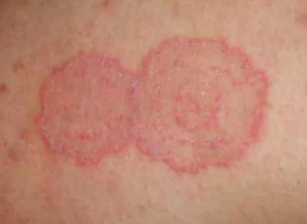 神經性皮炎的症狀都有哪些，與毛囊炎有關係嗎？