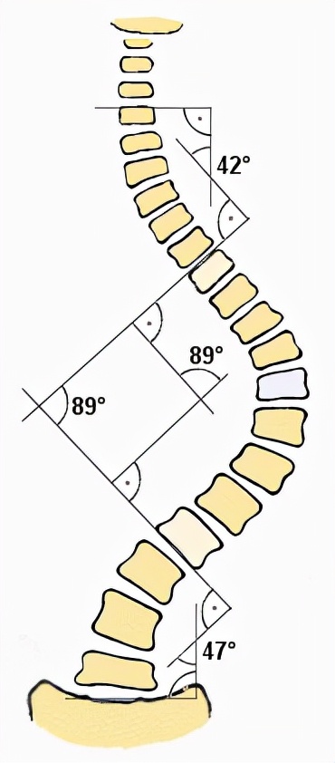 22根鋼釘+折斷3根肋骨，是我變“直”的代價