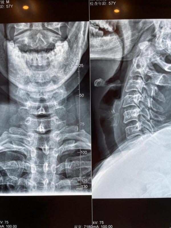 腰椎間盤突出患者應該如何鍛鍊