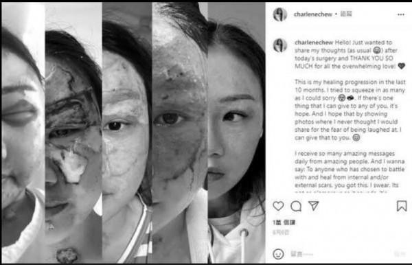 新加坡“勵志”女網紅歐洲遊不幸被感染，分享慘痛經歷