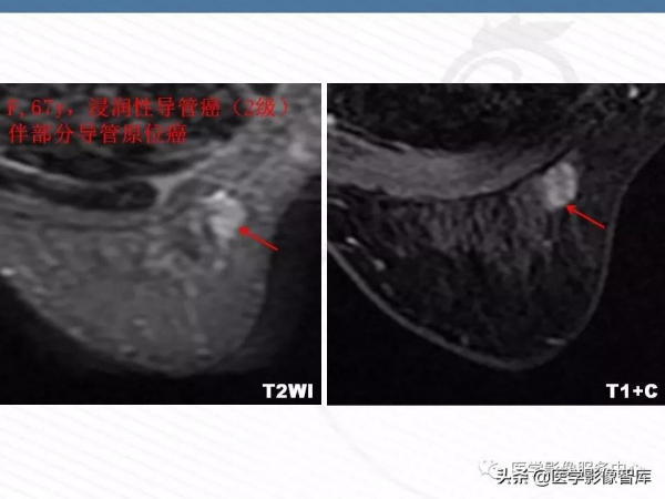 乳腺T2WI高訊號腫瘤病變的診斷思路 乳腺T2WI高訊號腫瘤病變的診斷思路