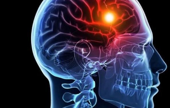 這6類人是腦中風高風險人群,要注意保養 這6類人是腦中風高風險人群,要注意保養