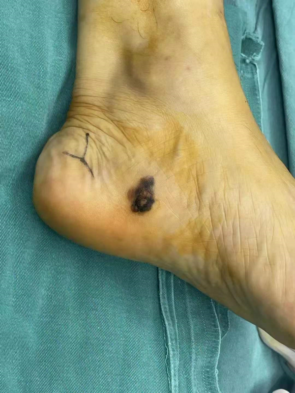 53歲的大叔腳後跟長了一個&OpenCurlyDoubleQuote;雞眼&rdquo;，變大變黑，醫生：幸虧來得早