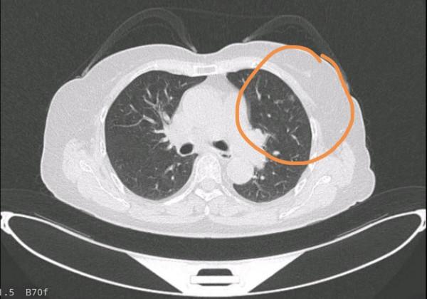 北大人民醫院劉醫生:父親查出了肺癌,希望放棄治療,我沒同意 北大人民醫院劉醫生:父親查出了肺癌,希望放棄治療,我沒同意