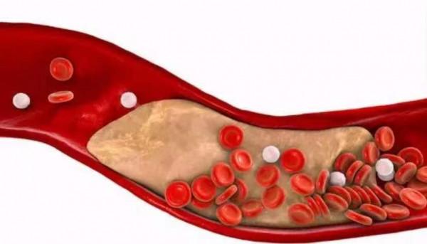 血脂恢復正常了，他汀類藥物能不能減半服用？本文為你講清楚