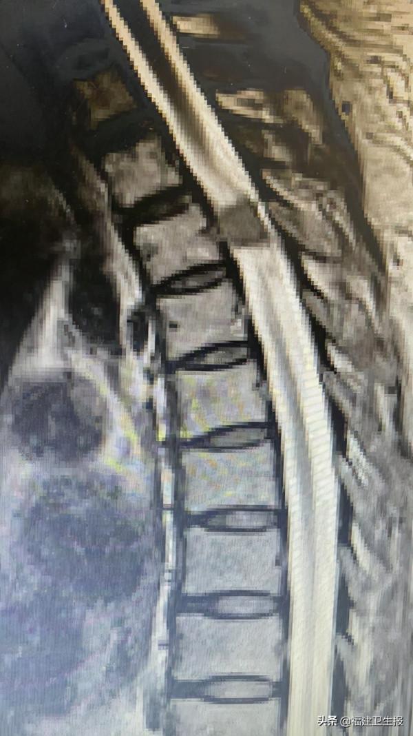 全球首例！福建省立醫院徐傑團隊創新手術為七旬老人精準拆“彈”