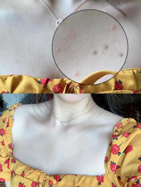 精緻豬豬女孩的身上怎麼可以有痘痘呢？