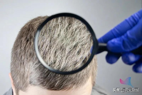 為什麼壓力大時會長白頭髮？