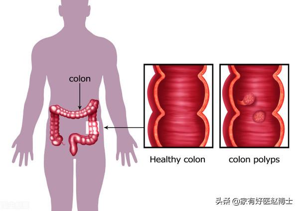 最常見5類息肉每個人都可能有，哪些無癌變風險，哪些需要切除？
