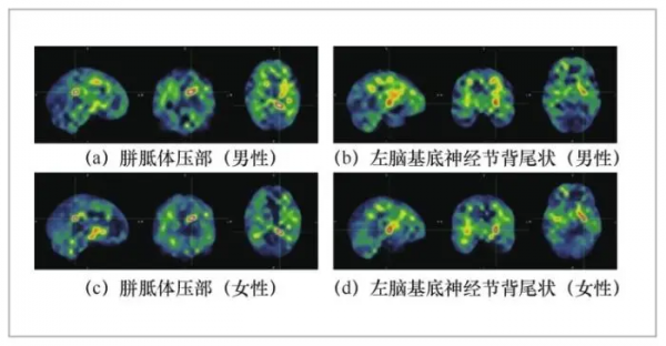 基於深度學習的大腦性別差異分析 基於深度學習的大腦性別差異分析
