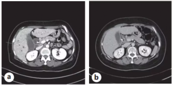 脂質體伊立替康耐藥了竟然還可以再用