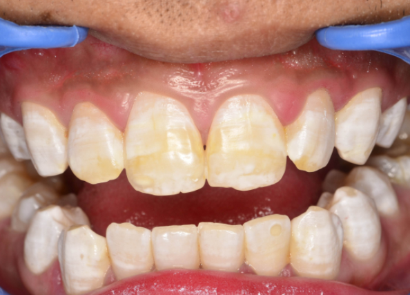 氟斑牙治不好？老牙醫：這幾個方法可以改善