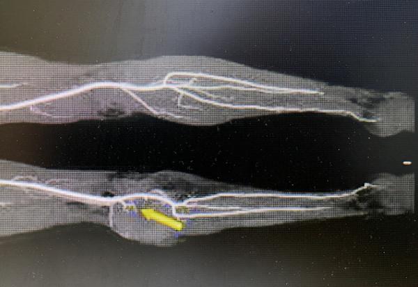 良性腫瘤就不需要處理？連續發作：15釐米的巨大瘤令人瞠目