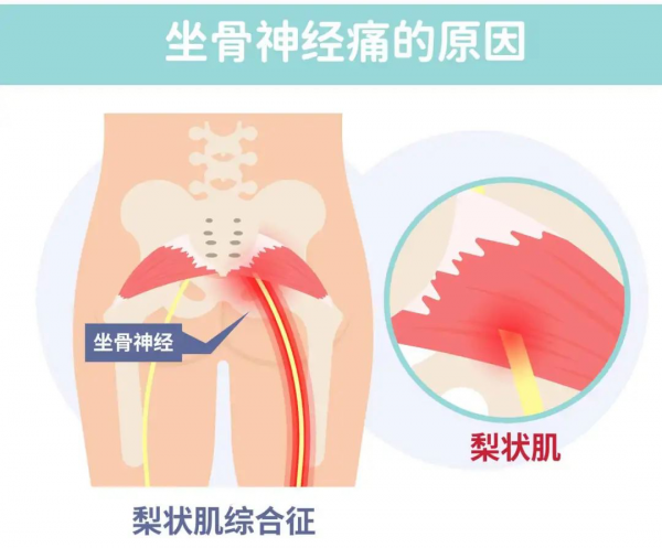 久坐腰腿痛怎麼辦？3 個動作輕鬆緩解