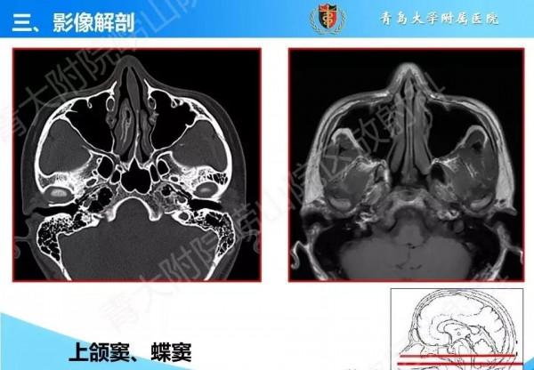 頭頸五官CT斷層解剖圖及常見病影像診斷