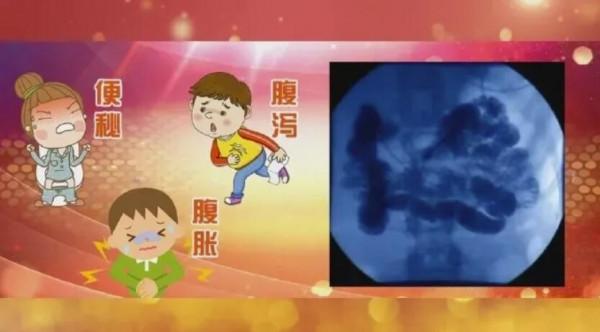 容易便秘、腹瀉?小心腸道老化了!調理腸道兩步走,為腸道“減齡”添活力 容易便秘、腹瀉?小心腸道老化了!調理腸道兩步走,為腸道“減齡”添活力