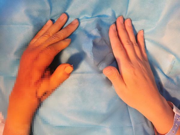 陝西省第四人民醫院首例拇指全形再造手術獲得成功