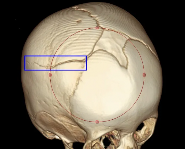 一份放射科醫師的值班日記，告訴你兒童意外傷害有多可怕