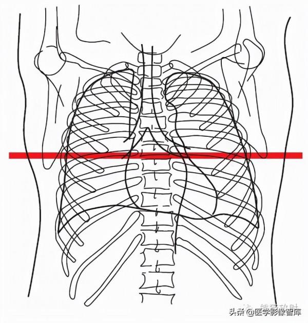 CT斷層解剖圖譜最全總結「推薦收藏」 CT斷層解剖圖譜最全總結「推薦收藏」