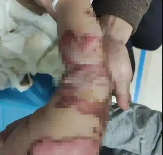 心疼!1歲幼童尿床後被電熱毯燒傷…… 心疼!1歲幼童尿床後被電熱毯燒傷……