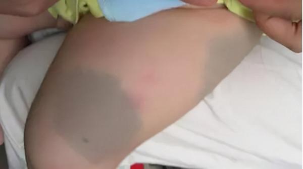 新生兒屁股有“淤青”是怎麼回事?不是投胎時被踢,或與爸媽有關 新生兒屁股有“淤青”是怎麼回事?不是投胎時被踢,或與爸媽有關