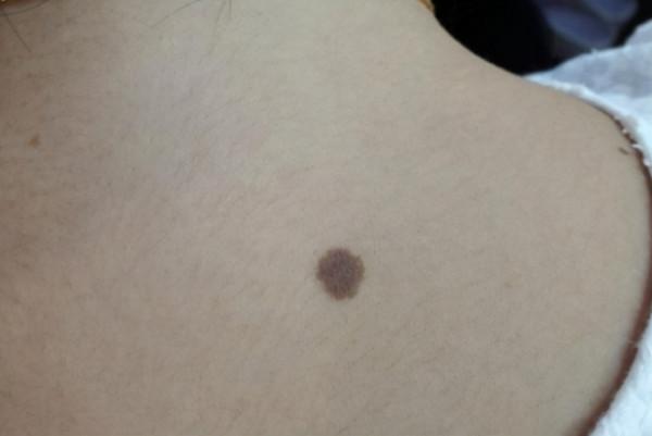 為何有些人脖子後邊都有一顆“痣”？是好是壞？原來並不是巧合