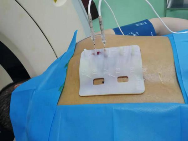 南溪山醫院依託3D列印技術為神經痛患者開展射頻治療