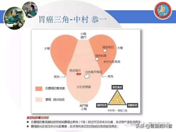 早期胃癌——內鏡診治流程