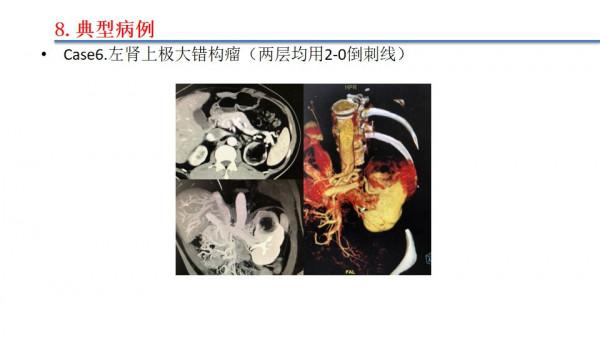 南昌大學二附院泌尿外科江偉凡博士分享腹腔鏡腎部分切除術治療複雜腎腫瘤的新進展及疑難病例