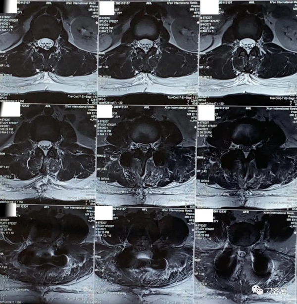 27歲女性，兩間隙腰椎間盤突出症，6顆釘子，4個融合器