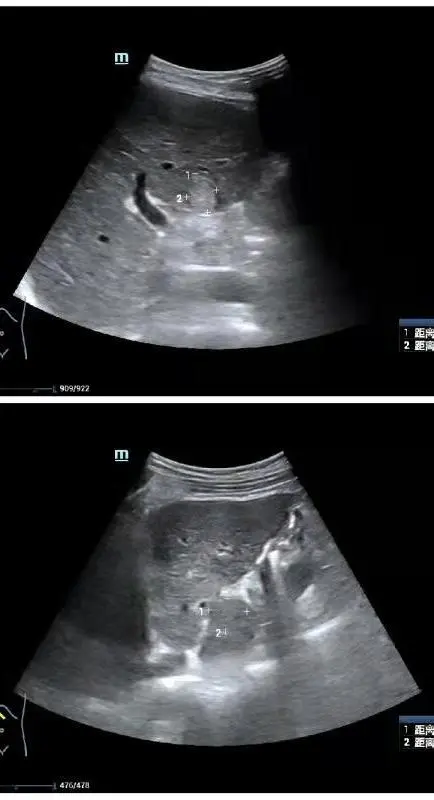 心急如焚!他的癌症很可能復發了 心急如焚!他的癌症很可能復發了