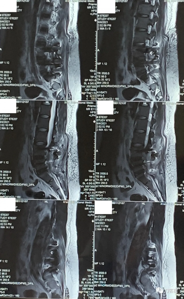 27歲女性，兩間隙腰椎間盤突出症，6顆釘子，4個融合器