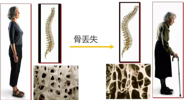鹽吃多了對身體不好！餐桌上的5種“高鹽食物”，勸你和家人少吃