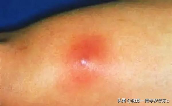 蒲地藍消炎片是萬能消炎藥？哪些情況不能用？專業藥師幫您解讀