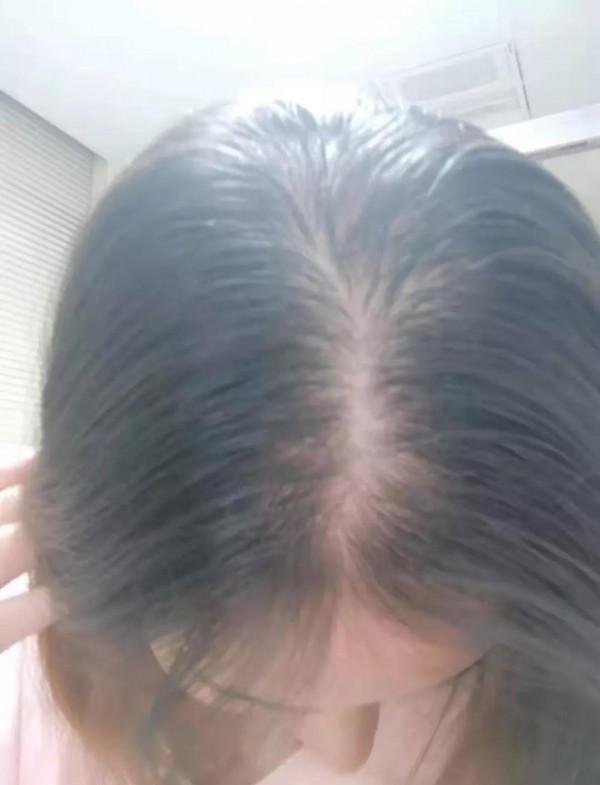 脂溢性脫髮真的治不好嗎