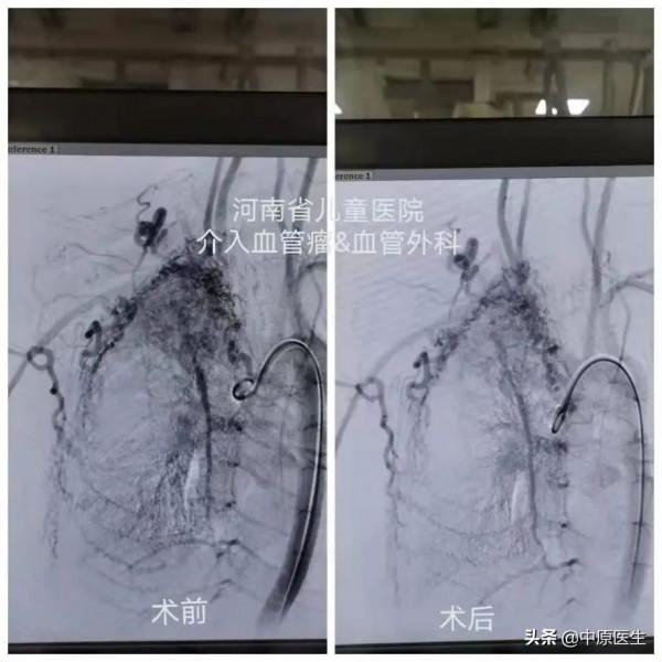 13歲男孩咳嗽，家長以為是感冒或肺炎，被兒童醫院查出特殊病因