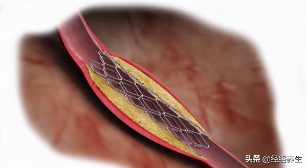 心梗的風險早知道,胃痛怎麼就變成了心梗?有這些症狀要仔細分辨 心梗的風險早知道,胃痛怎麼就變成了心梗?有這些症狀要仔細分辨
