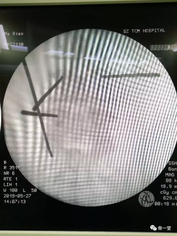 真正的脊柱微創-misTLIF入路經脊柱內鏡下椎管減壓融合治療