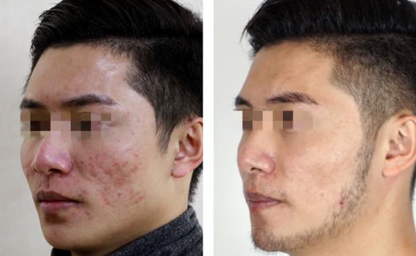 小夥5年老舊痘坑痘印,積極接受治療稱:面部痘坑痘印快消失了 小夥5年老舊痘坑痘印,積極接受治療稱:面部痘坑痘印快消失了