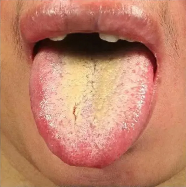 中醫醫案分析：打針無效的重症感冒患者