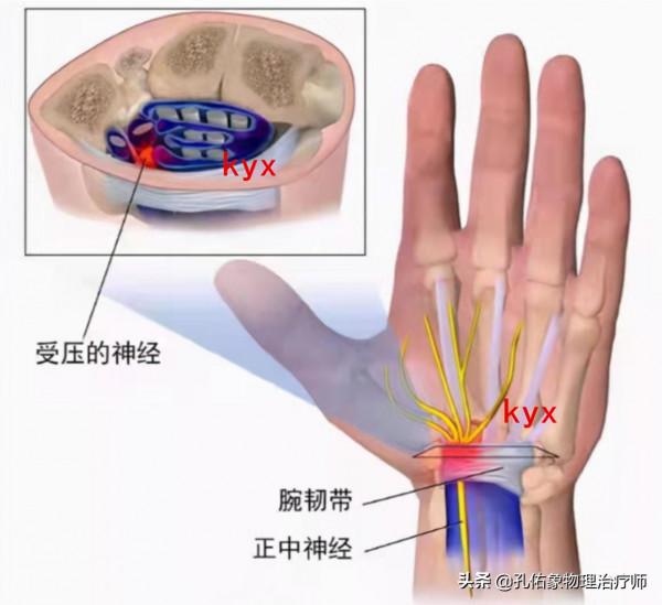 手指發脹、僵硬、握不攏，是風溼嗎？不出意外，這4種可能性較大