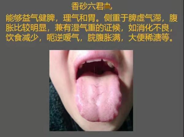 舌有齒痕？脾虛？怎麼辦