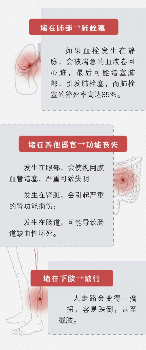 一塊「血栓」的危險漂流之旅 一塊「血栓」的危險漂流之旅